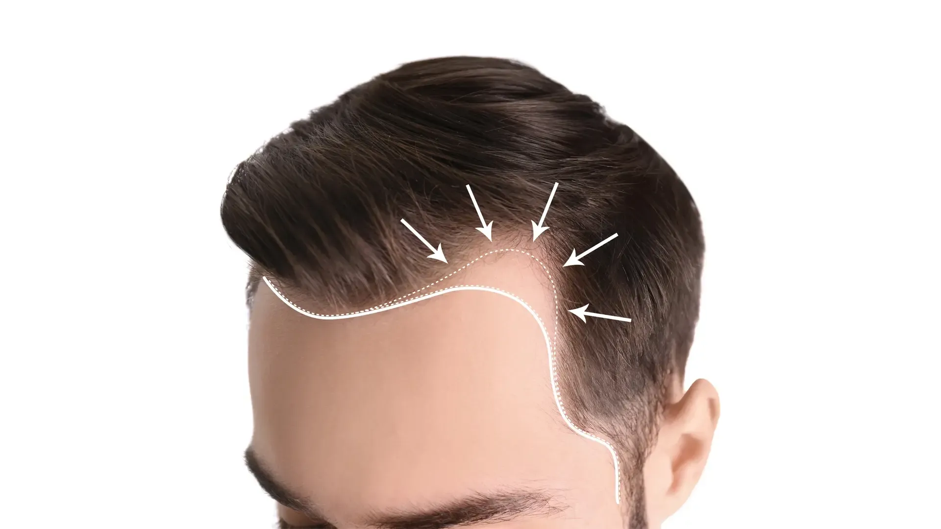DHI Saç Ekimi